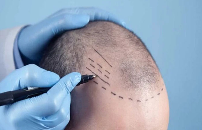 عملية زراعة الشعر بالاقتطاف