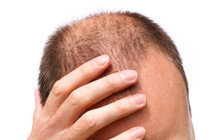 كم سعر زراعة الشعر