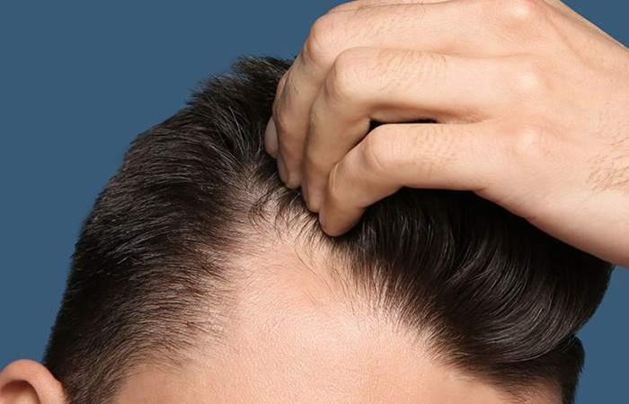 اخر تقنيات زراعة الشعر