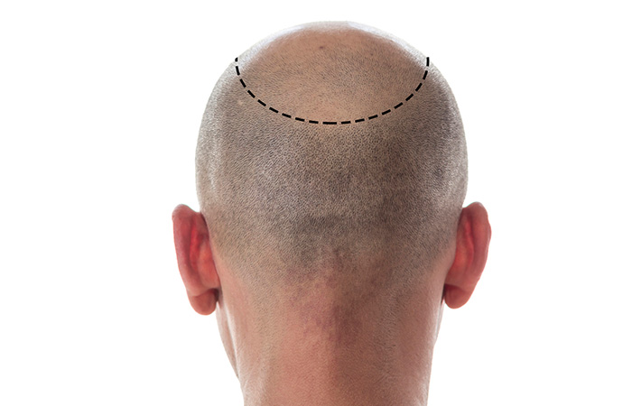 افضل تقنيات زراعة الشعر