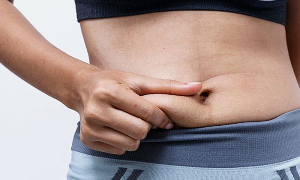 علاج ترهلات بعد فقدان الوزن