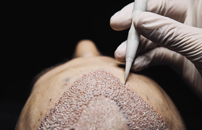 تقنية اقلام تشوي لزراعة الشعر