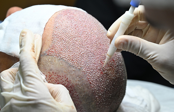 تقنية جديدة لزراعة الشعر