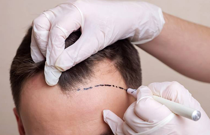 تقنية زراعة الشعر
