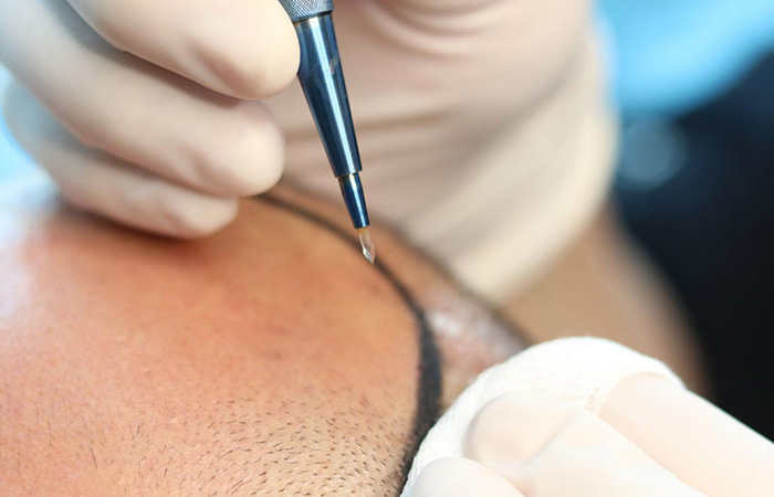 تقنية سفير لزراعة الشعر
