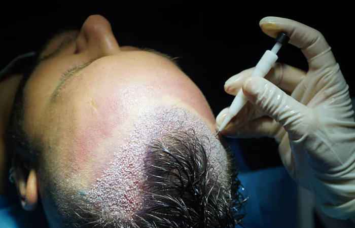 زراعة الشعر dhi 7