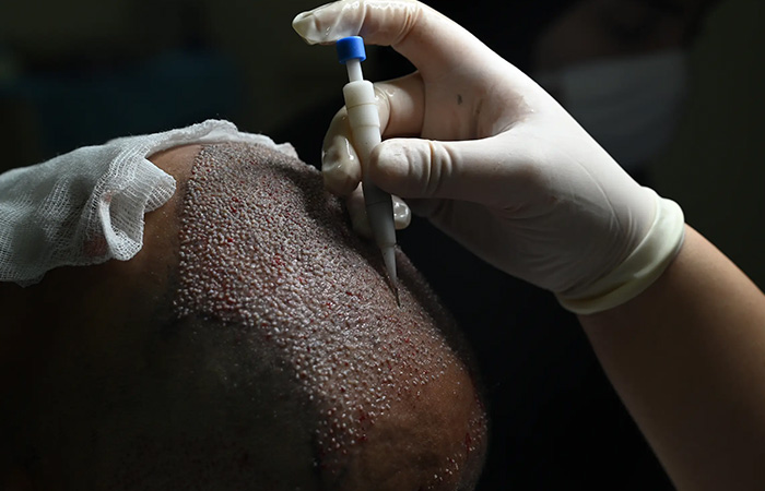 زراعة الشعر باقلام تشوي