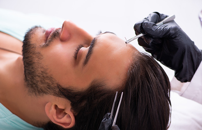 زراعة الشعر بتقنية الاقتطاف