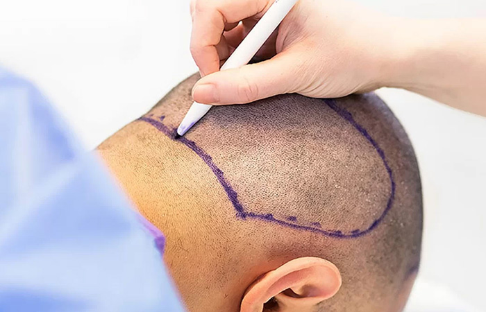 زراعة الشعر بتقنية البيركوتان