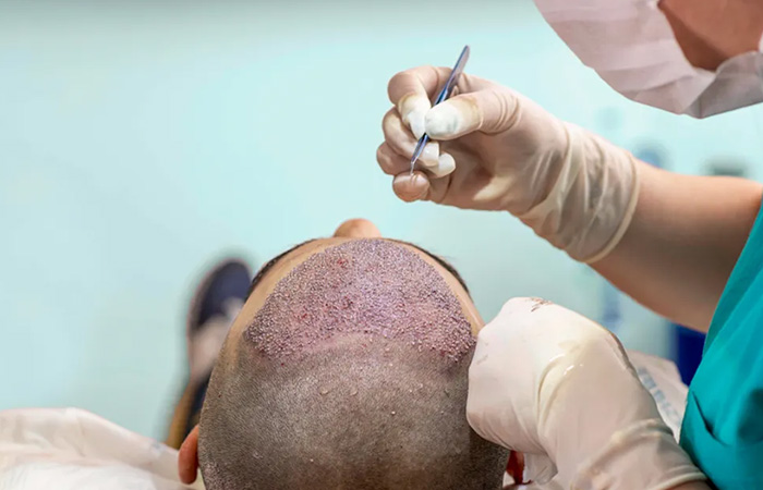زرع الشعر بالاقتطاف