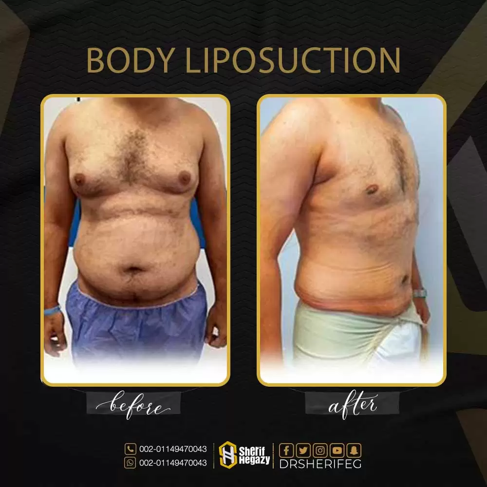 علاج التثدي للرجال