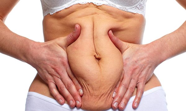 علاج ترهلات الجلد