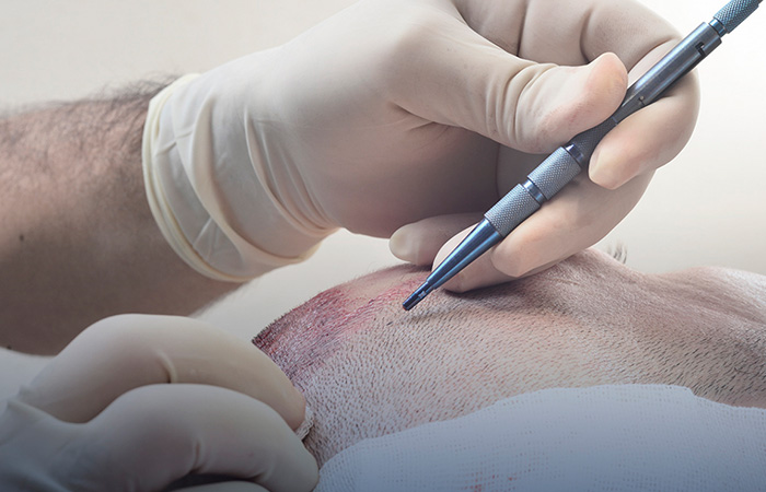 ماهي تقنية السفير لزراعة الشعر