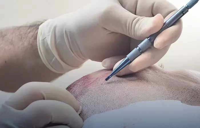 ماهي تقنية السفير لزراعة الشعر