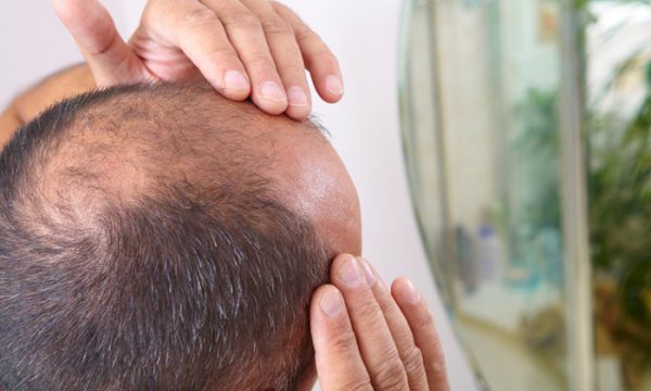 اسباب الصلع عند الرجال