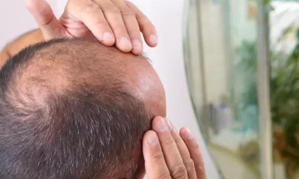 اسباب الصلع عند الرجال