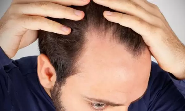 الصلع الوراثي المبكر
