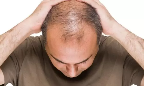 الصلع الوراثي عند الرجال