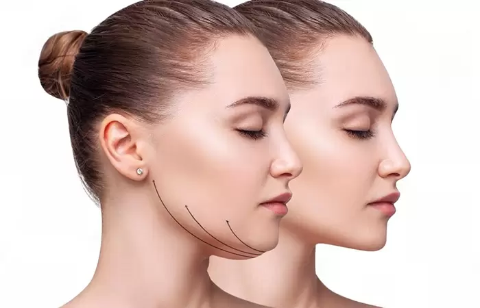 تورم الوجه بعد عملية شد الوجه