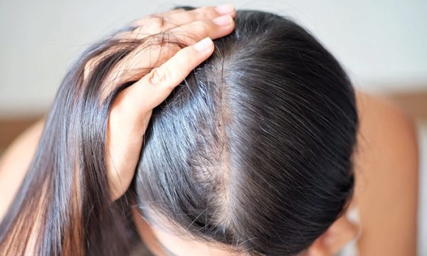 أسباب تساقط الشعر عند النساء