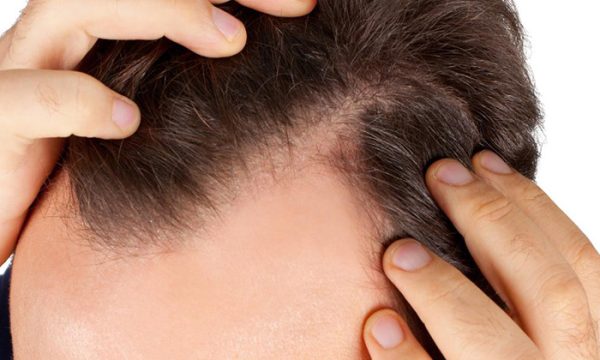 اسباب تساقط الشعر عند الشباب