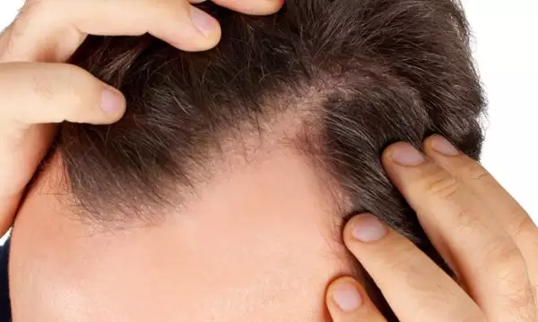 اسباب تساقط الشعر عند الشباب