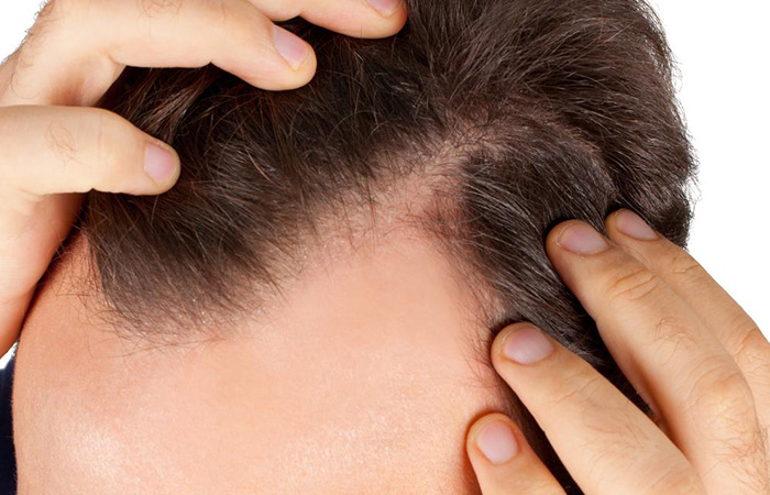 اسباب تساقط الشعر عند الشباب
