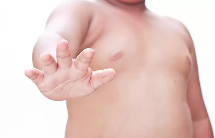 التثدى عند الاطفال