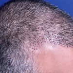 تساقط الشعر المزروع بعد 10 أيام