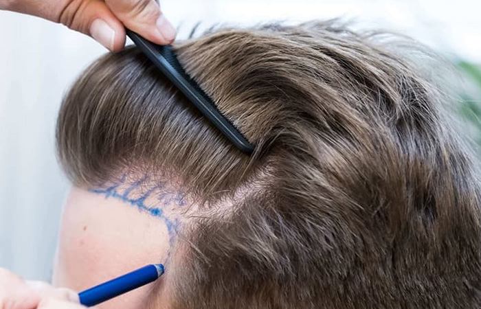 تعليمات بعد زراعة الشعر