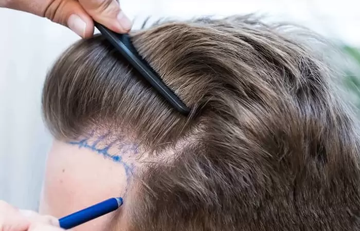تعليمات بعد زراعة الشعر