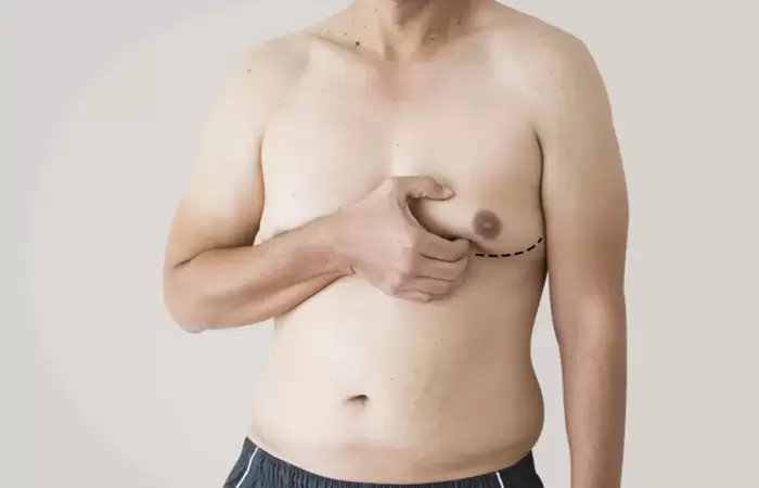 علاج تثدي الرجال