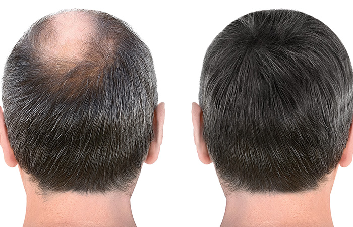 مراحل زراعة الشعر بالصور