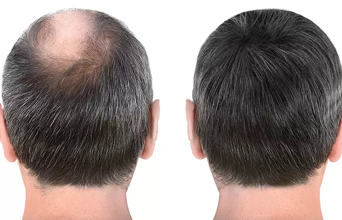 مراحل زراعة الشعر بالصور