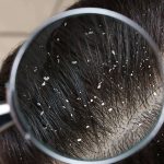 أسباب القشرة وتساقط الشعر