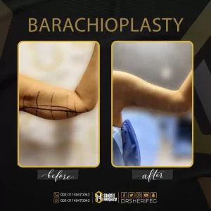 أسباب ترهل الذراعين عند النساء