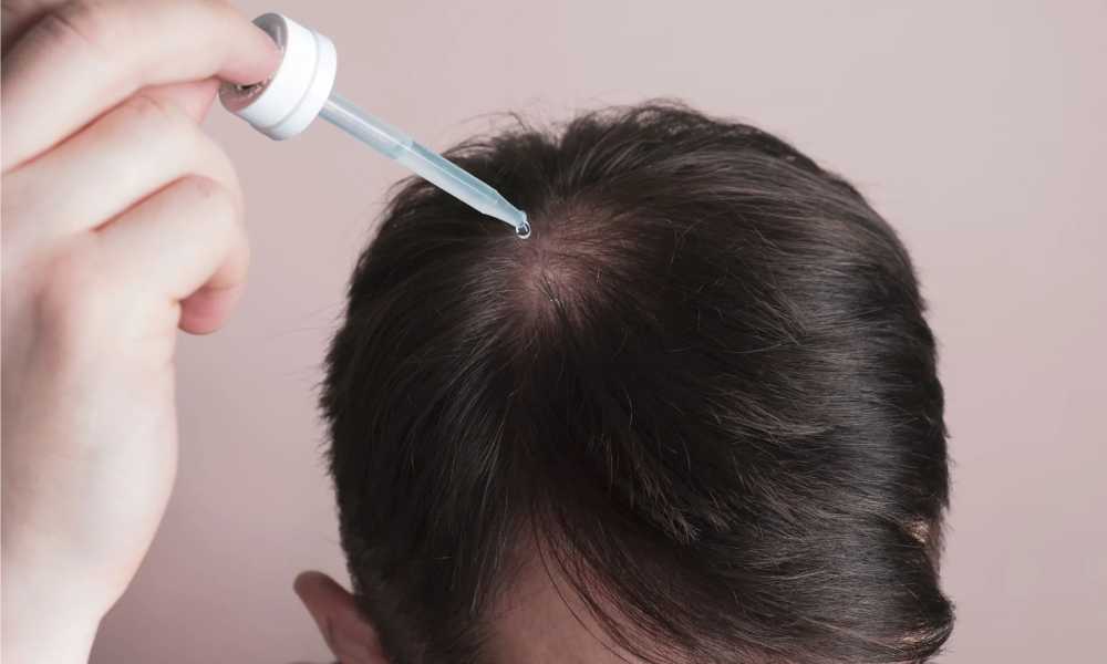 طريقة استخدام مينوكسيديل