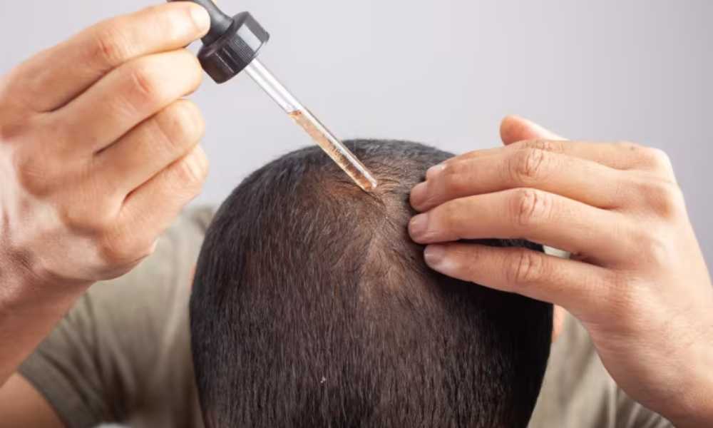 استخدام المينوكسيديل وفوائده الـ 5 ونصائح هامة