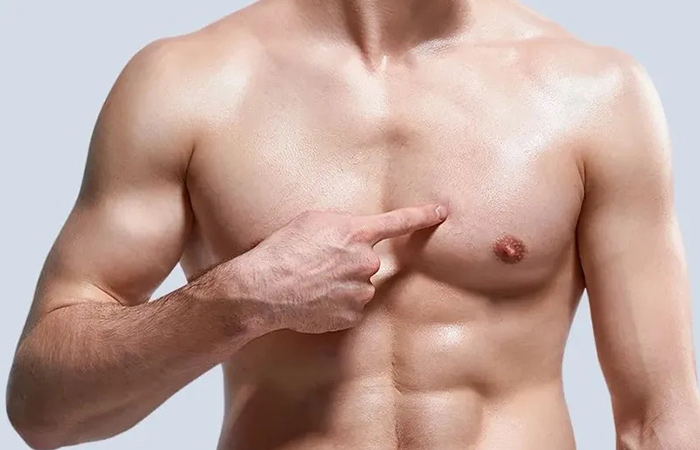 التثدي عند الرجال وعلاجه