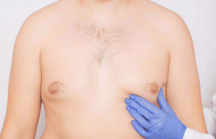 علاج التثدي لدى الرجال