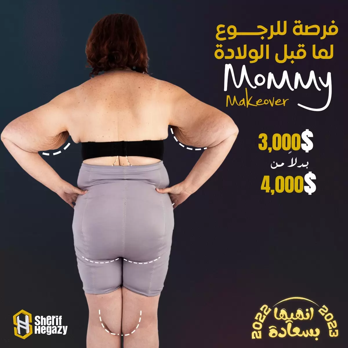 mommy makeover offer