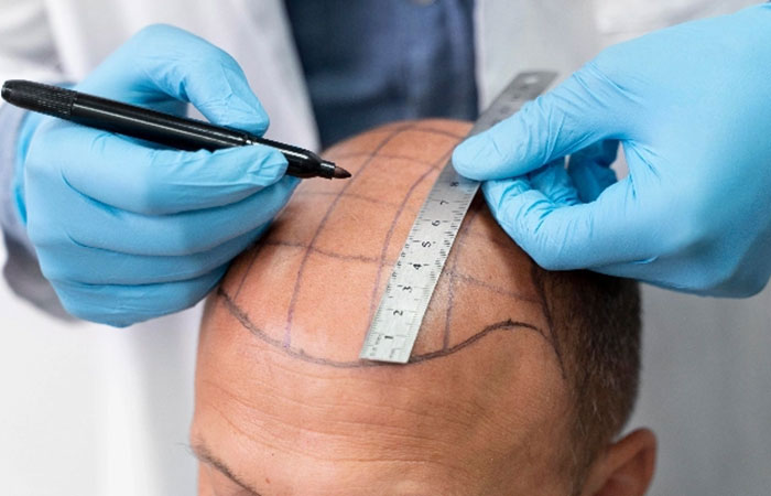 أرخص مراكز زراعة الشعر في مصر