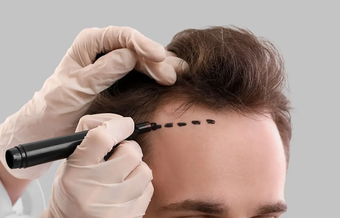 الأكل الممنوع بعد زراعة الشعر