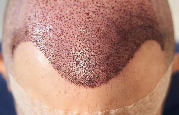 اليوم الخامس بعد زراعة الشعر