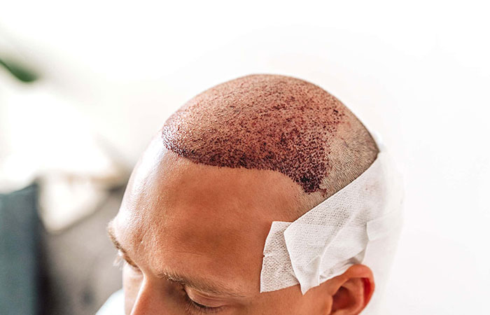 بعد 15 يوم من زراعة الشعر