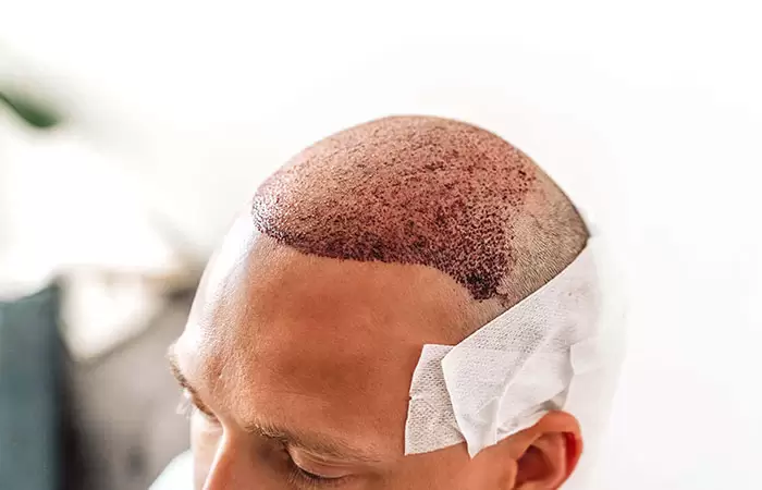 بعد 15 يوم من زراعة الشعر