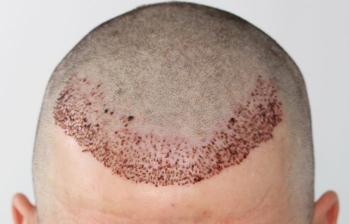 بعد 20 يوم من زراعة الشعر