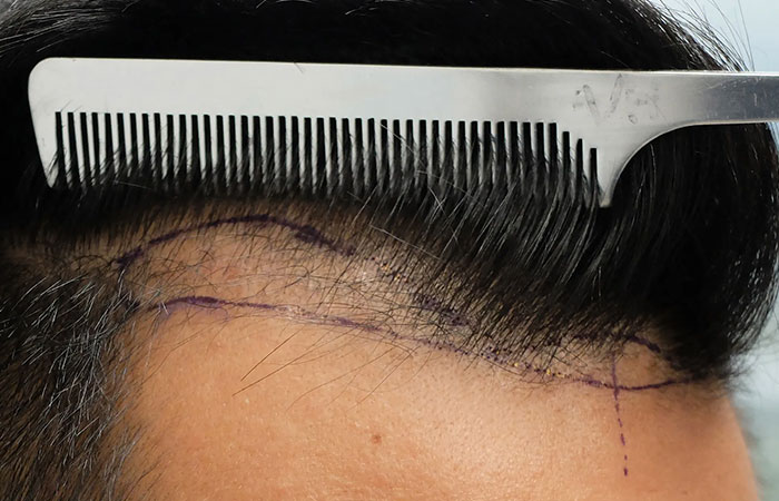 زراعة الشعر بالتقسيط في مصر