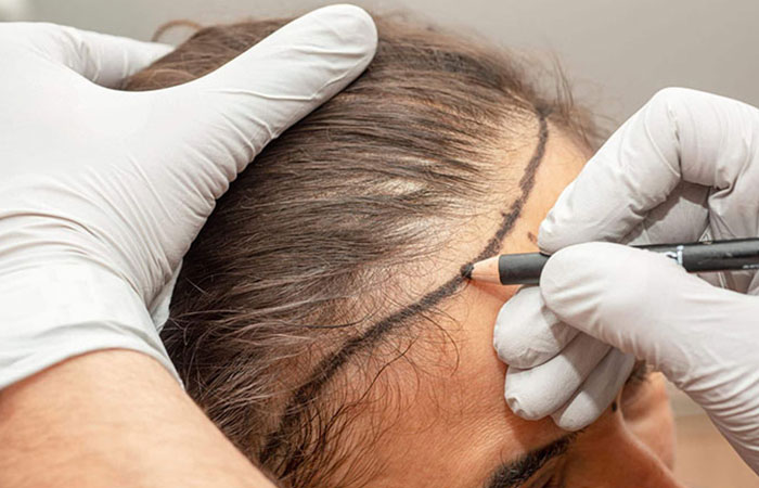 سعر زراعة الشعر في الجبهة