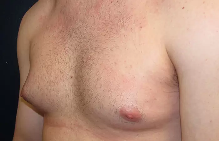 علاج التثدي الكاذب 